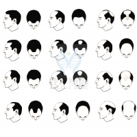 【royal皇家88基因检测】过早<font color='red'>脱发</font>、掉发太多怎么办？你的方法可能是错的！
